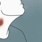 How to Remove a Hickey in Seconds with Toothpaste Fast Beauty Fixes