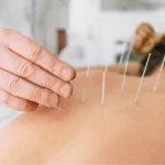 Dry Needling Demystified: Sciatica Relief Through Therapy 34 AtlanticRide
